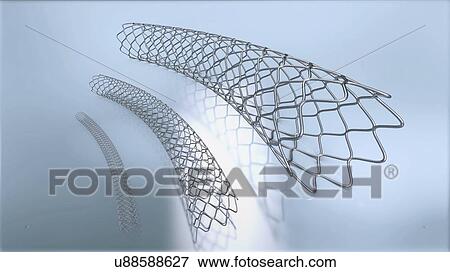 Stent, illustration View Large Photo Image Stock Photo - Stent, illustration. Fotosearch