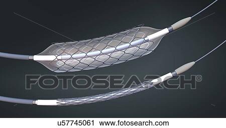Stock Image - Stents and balloon catheters, illustration. Fotosearch