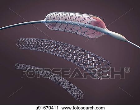 Stock Image - Stents and balloon catheters, illustration. Fotosearch