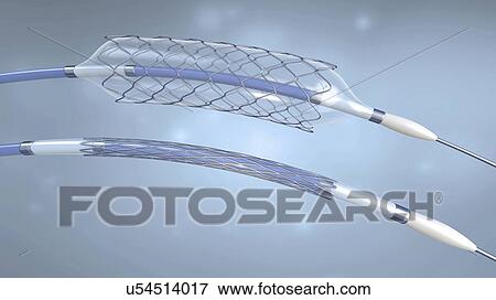 Stents and balloon catheters, illustration View Large Photo Image Stock Photo - Stents and balloon catheters, illustration. Fotosearch