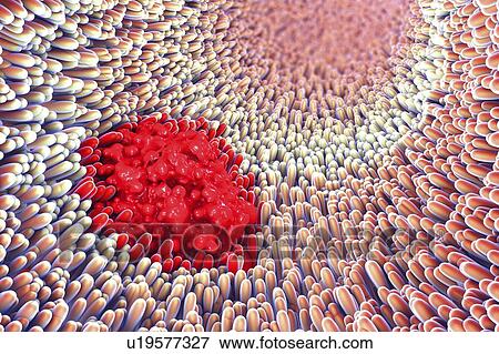 Stock Photo - Stomach ulcer, illustration. Fotosearch