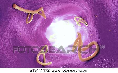 Tapeworm infestation in human intestine, illustration View Large Photo Image Stock Image - Tapeworm infestation in human intestine, illustration. Fotosearch