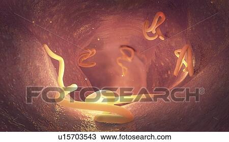 Stock Image - Tapeworm infestation in human intestine, illustration. Fotosearch