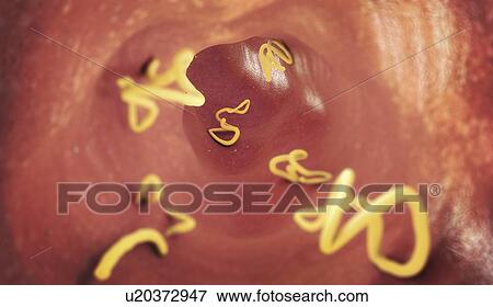 Stock Photo - Tapeworm infestation in human intestine, illustration. Fotosearch