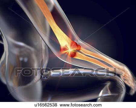 Stock Photo - Tennis elbow, illustration. Fotosearch