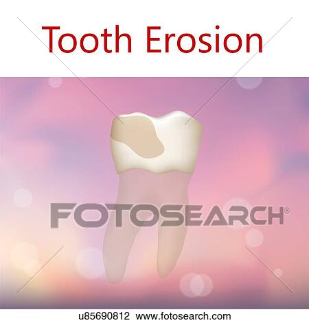 Stock Image - Tooth erosion, illustration. Fotosearch