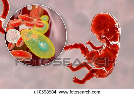 Transplacental transmission of Toxoplasmosis, illustration View Large Photo Image Picture - Transplacental transmission of Toxoplasmosis, illustration. Fotosearch