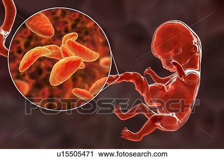 Stock Image - Transplacental transmission of Toxoplasmosis, illustration. Fotosearch