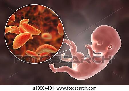 Stock Image - Transplacental transmission of Toxoplasmosis, illustration. Fotosearch