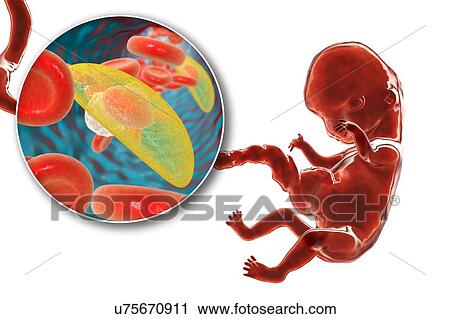Stock Image - Transplacental transmission of Toxoplasmosis, illustration. Fotosearch