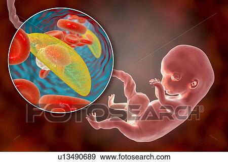 Stock Photo - Transplacental transmission of Toxoplasmosis, illustration. Fotosearch