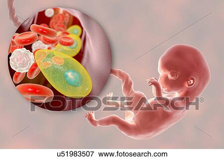 Transplacental transmission of Toxoplasmosis, illustration View Large Photo Image Stock Photo - Transplacental transmission of Toxoplasmosis, illustration. Fotosearch