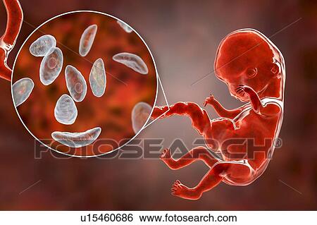 Transplacental transmission of Toxoplasmosis, illustration View Large Photo Image Stock Photograph - Transplacental transmission of Toxoplasmosis, illustration. Fotosearch
