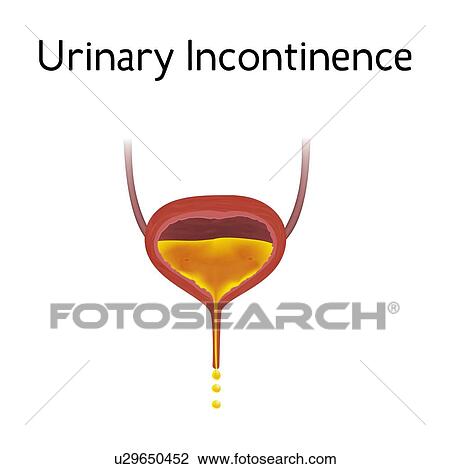 Stock Image - Urinary incontinence, illustration. Fotosearch