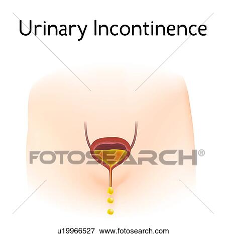 Urinary incontinence, illustration View Large Photo Image Stock Photo - Urinary incontinence, illustration. Fotosearch