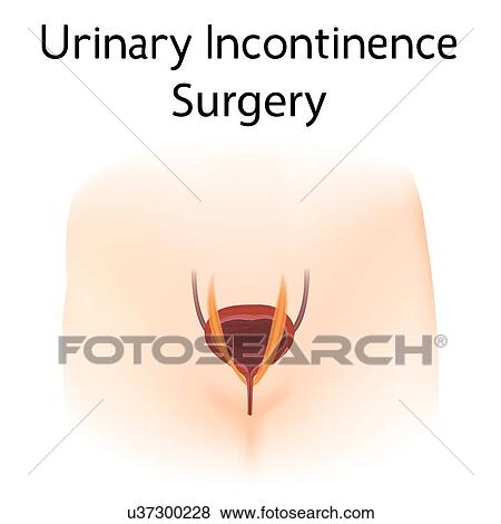Urinary incontinence surgery, illustration View Large Photo Image Stock Photo - Urinary incontinence surgery, illustration. Fotosearch