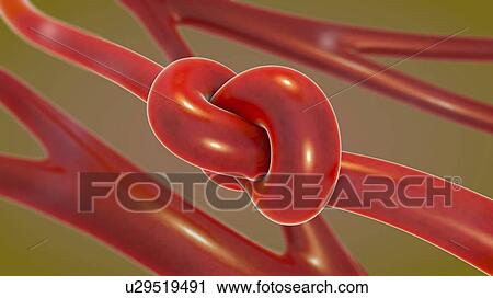 Stock Image - Vascular disease, conceptual illustration. Fotosearch