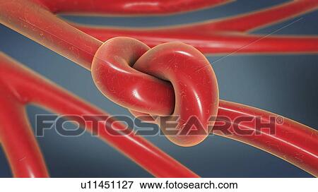 Stock Photo - Vascular disease, conceptual illustration. Fotosearch