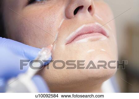 Picture - Woman having hyaluronic acid injections. Fotosearch