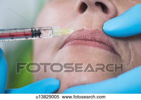 Woman having hyaluronic acid injections View Large Photo Image Stock Photography - Woman having hyaluronic acid injections. Fotosearch