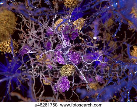 Stock Photo - Alzheimer's disease. Computer illustration of amyloid plaques (yellow) amongst neurons. Amyloid plaques are characteristic features of Alzheimer's disease. They lead to degeneration of the affected neurons, which are destroyed through the activity of.... Fotosearch