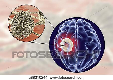 Aspergilloma of the brain and close-up view of Aspergillus fungi, computer illustration. Also known as mycetoma, or fungus ball, this is an intracranial lesion produced by Aspergillus fungi in immunocompromised patients. View Large Photo Image Picture - Aspergilloma of the brain and close-up view of Aspergillus fungi, computer illustration. Also known as mycetoma, or fungus ball, this is an intracranial lesion produced by Aspergillus fungi in immunocompromised patients.. Fotosearch