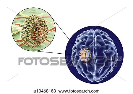 Stock Image - Aspergilloma of the brain and close-up view of Aspergillus fungi, computer illustration. Also known as mycetoma, or fungus ball, this is an intracranial lesion produced by Aspergillus fungi in immunocompromised patients.. Fotosearch