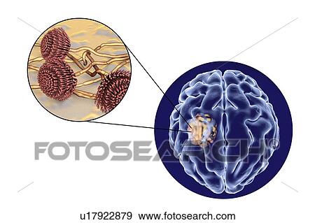 Stock Photo - Aspergilloma of the brain and close-up view of Aspergillus fungi, computer illustration. Also known as mycetoma, or fungus ball, this is an intracranial lesion produced by Aspergillus fungi in immunocompromised patients.. Fotosearch