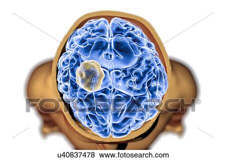 Aspergilloma of the brain and close-up view of Aspergillus fungi, computer illustration. Also known as mycetoma, or fungus ball, this is an intracranial lesion produced by Aspergillus fungi in immunocompromised patients. View Large Photo Image Stock Photo - Aspergilloma of the brain and close-up view of Aspergillus fungi, computer illustration. Also known as mycetoma, or fungus ball, this is an intracranial lesion produced by Aspergillus fungi in immunocompromised patients.. Fotosearch