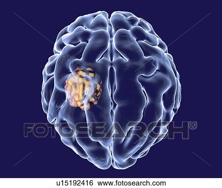 Stock Photograph - Aspergilloma of the brain and close-up view of Aspergillus fungi, computer illustration. Also known as mycetoma, or fungus ball, this is an intracranial lesion produced by Aspergillus fungi in immunocompromised patients.. Fotosearch