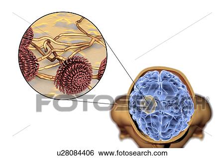 Stock Photograph - Aspergilloma of the brain and close-up view of Aspergillus fungi, computer illustration. Also known as mycetoma, or fungus ball, this is an intracranial lesion produced by Aspergillus fungi in immunocompromised patients.. Fotosearch
