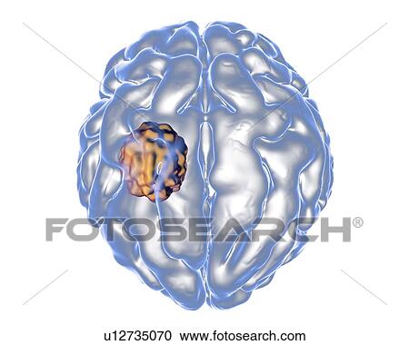 Stock Image - Aspergilloma of the brain, illustration. Also known as mycetoma, or fungus ball, this is an intracranial lesion produced by Aspergillus fungi in immunocompromised patients.. Fotosearch