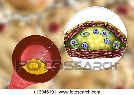 Atheromatous plaque inside blood vessel, computer illustration. A cholesterol atheroma is causing a narrowing of an artery (atherosclerosis). The inset shows a cross-section of the plaque and its histological structure, such as necrotic centre, foam... View Large Photo Image Stock Image - Atheromatous plaque inside blood vessel, computer illustration. A cholesterol atheroma is causing a narrowing of an artery (atherosclerosis). The inset shows a cross-section of the plaque and its histological structure, such as necrotic centre, foam.... Fotosearch