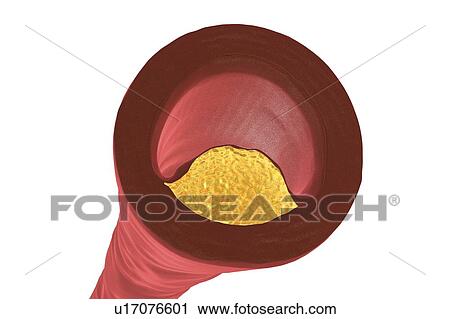 Stock Image - Atheromatous plaque inside blood vessel, computer illustration. A cholesterol atheroma is causing a narrowing of an artery (atherosclerosis).. Fotosearch