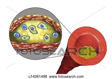 Stock Photo - Atheromatous plaque inside blood vessel, computer illustration. A cholesterol atheroma is causing a narrowing of an artery (atherosclerosis). The inset shows a cross-section of the plaque and its histological structure, such as necrotic centre, foam.... Fotosearch