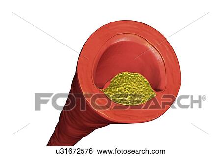 Stock Photograph - Atheromatous plaque inside blood vessel, computer illustration. A cholesterol atheroma is causing a narrowing of an artery (atherosclerosis).. Fotosearch