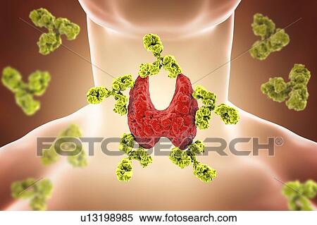 Autoimmune thyroiditis (Hashimoto's disease), conceptual illustration. Antibodies are attacking the thyroid gland. View Large Photo Image Stock Photography - Autoimmune thyroiditis (Hashimoto's disease), conceptual illustration. Antibodies are attacking the thyroid gland.. Fotosearch