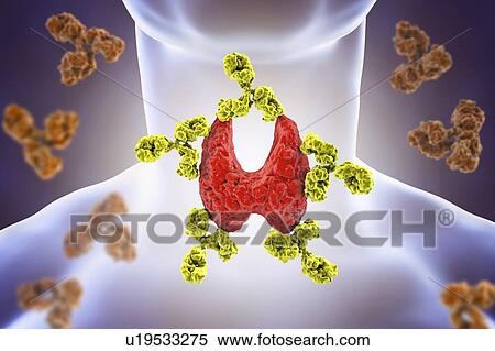Stock Photography - Autoimmune thyroiditis (Hashimoto's disease), conceptual illustration. Antibodies are attacking the thyroid gland.. Fotosearch
