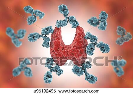 Autoimmune thyroiditis (Hashimoto's disease), conceptual illustration. Antibodies are attacking the thyroid gland. View Large Photo Image Stock Photography - Autoimmune thyroiditis (Hashimoto's disease), conceptual illustration. Antibodies are attacking the thyroid gland.. Fotosearch