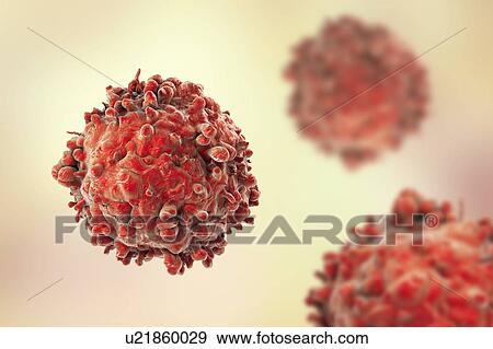 Stock Photo - Computer illustration of a cancerous white blood cell in leukaemia.. Fotosearch