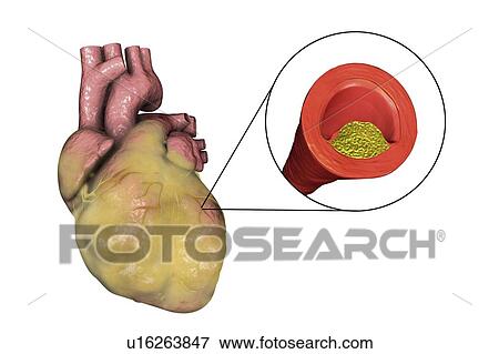 Computer illustration of a fatty heart and a coronary artery narrowed by a fatty plaque. View Large Photo Image Stock Photo - Computer illustration of a fatty heart and a coronary artery narrowed by a fatty plaque.. Fotosearch