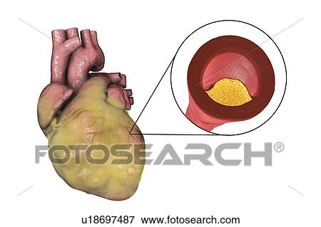 Computer illustration of a fatty heart and a coronary artery narrowed by a fatty plaque. View Large Photo Image Stock Photo - Computer illustration of a fatty heart and a coronary artery narrowed by a fatty plaque.. Fotosearch