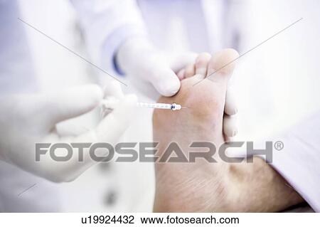 Stock Image - Dermatologist injecting botox into the sole of a foot to treat excessive sweating, close-up.. Fotosearch