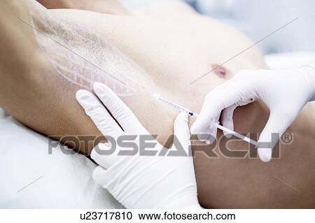 Dermatologist injecting botox into the underarm to treat excessive sweating, close-up. View Large Photo Image Stock Image - Dermatologist injecting botox into the underarm to treat excessive sweating, close-up.. Fotosearch