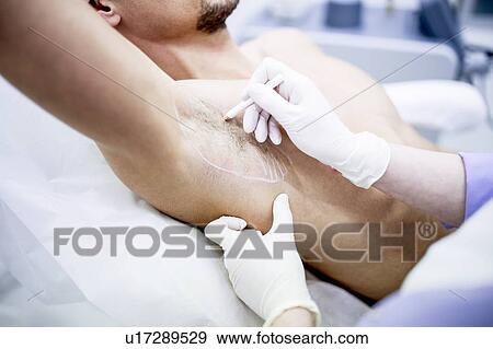 Dermatologist marking underarm for botox injection to treat excessive sweating, close-up. View Large Photo Image Stock Photo - Dermatologist marking underarm for botox injection to treat excessive sweating, close-up.. Fotosearch