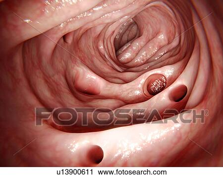 Stock Image - Diverticula in the large intestine, illustration. A diverticulum is a small pouch in the lining of the intestine.. Fotosearch