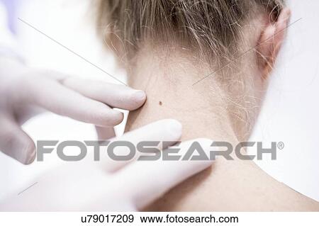 Stock Photo - Doctor examining patient's mole on neck.. Fotosearch