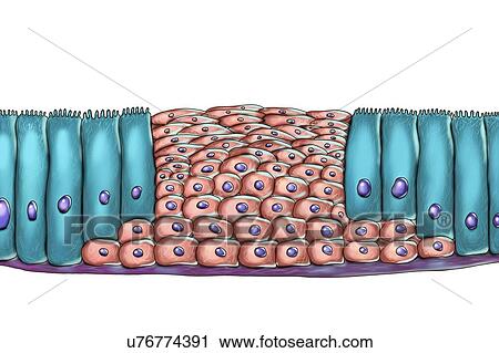 Stock Image - Epithelial metaplasia, computer illustration. Metaplasia is a change of cell type in a region. This illustration shows squamous metaplasia of respiratory epithelium, a consequence of cigarette smoking.. Fotosearch