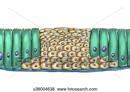 Stock Photo - Epithelial metaplasia, computer illustration. Metaplasia is a change of cell type in a region. This illustration shows squamous metaplasia of respiratory epithelium, a consequence of cigarette smoking.. Fotosearch