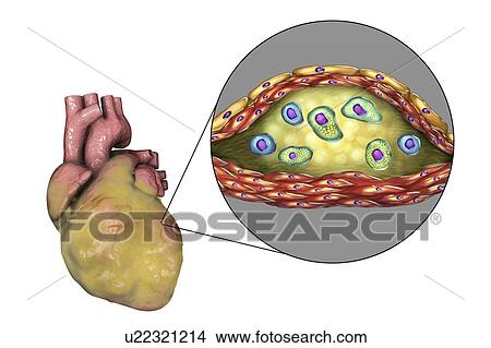 Heart disease, computer illustration. Diseased fatty heart and cross-section of an atherosclerotic plaque and its histological structure, such as necrotic centre, foam cells and T-lymphocytes. Its walls are made of smooth muscle cells and endothelium... View Large Photo Image Picture - Heart disease, computer illustration. Diseased fatty heart and cross-section of an atherosclerotic plaque and its histological structure, such as necrotic centre, foam cells and T-lymphocytes. Its walls are made of smooth muscle cells and endothelium.... Fotosearch